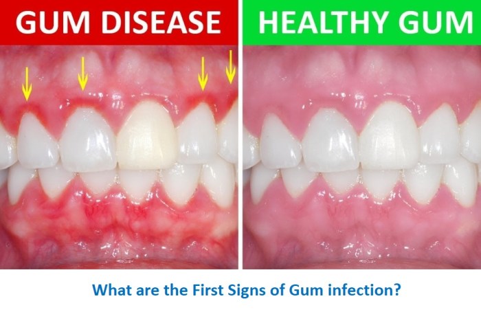 Gum disease remedies credit